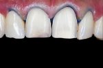 signs of weakening teeth symptoms