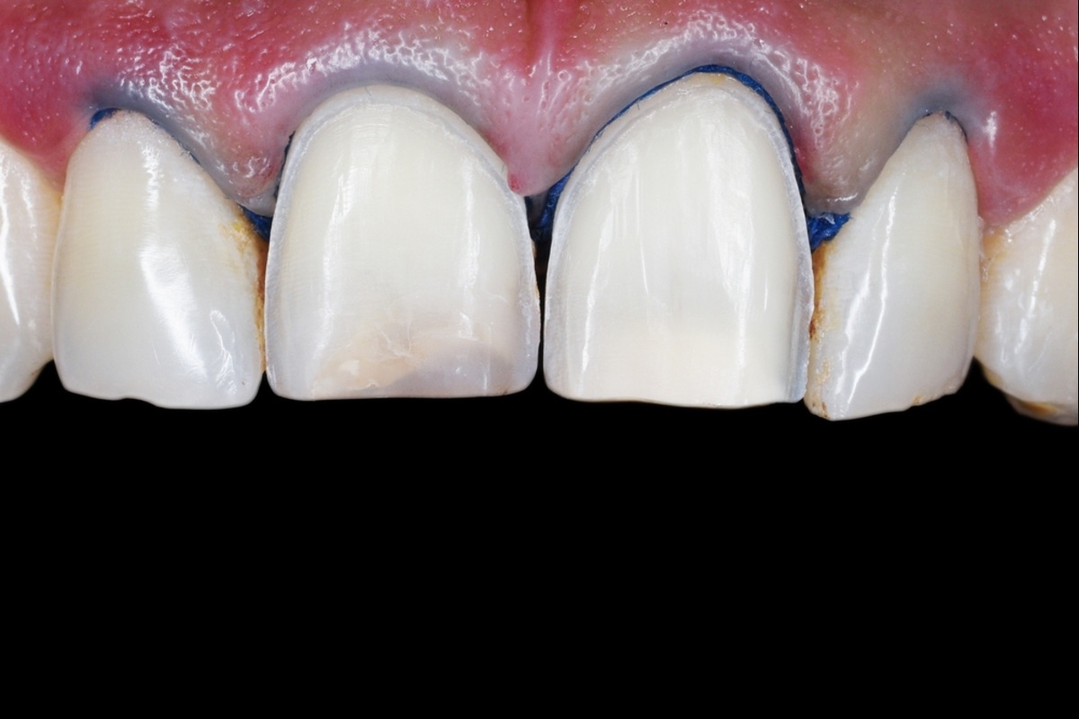 signs of weakening teeth symptoms