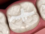 dental sealants
