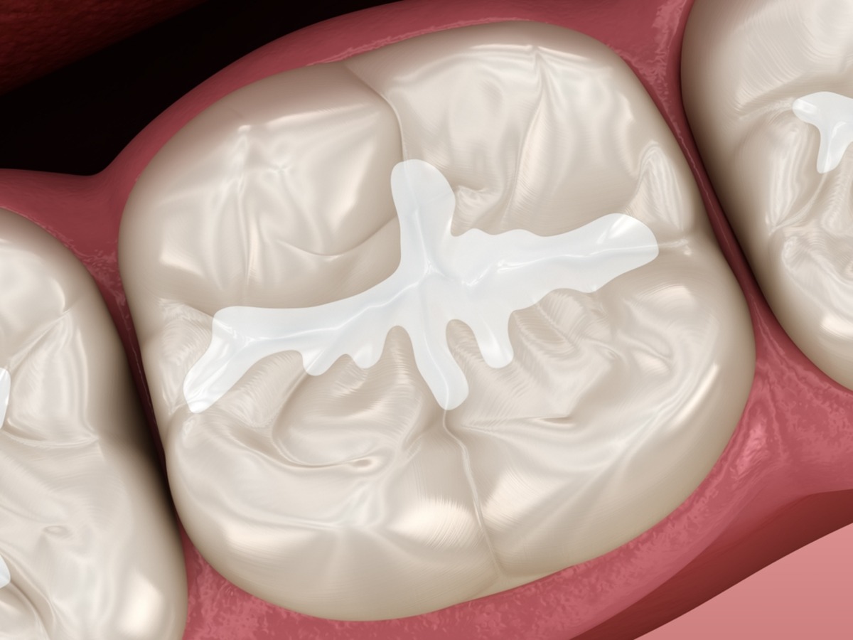 dental sealants