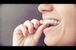 invisalign in peterborough