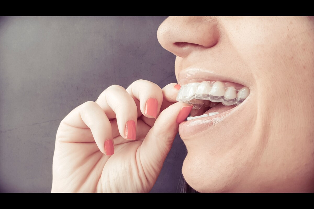 invisalign in peterborough