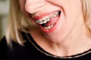 orthodontics in peterborough