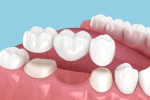 How to Make Your Dental Bridge Last 15 Years: Cleaning and Maintenance Tips