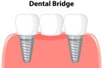 How to Make Your Dental Bridge Last 15 Years: Cleaning and Maintenance Tips