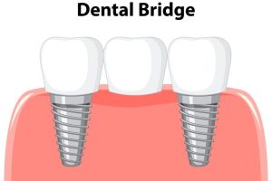 How to Make Your Dental Bridge Last 15 Years: Cleaning and Maintenance Tips
