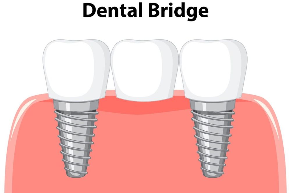 How to Make Your Dental Bridge Last 15 Years: Cleaning and Maintenance Tips