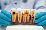 root canal treatment