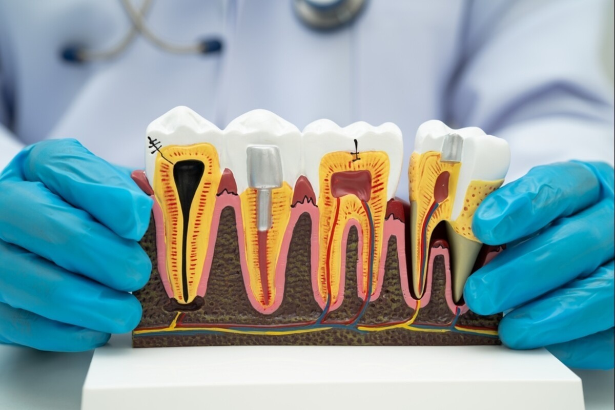 root canal treatment