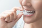 invisalign treatment stages