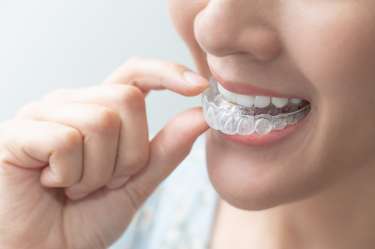 invisalign treatment stages