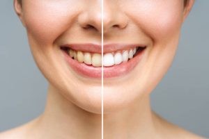 How Teeth Whitening Works: What You Need to Know for a Stunning Smile