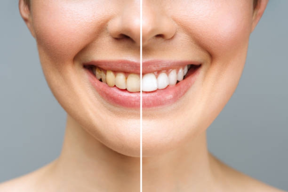 How Teeth Whitening Works: What You Need to Know for a Stunning Smile