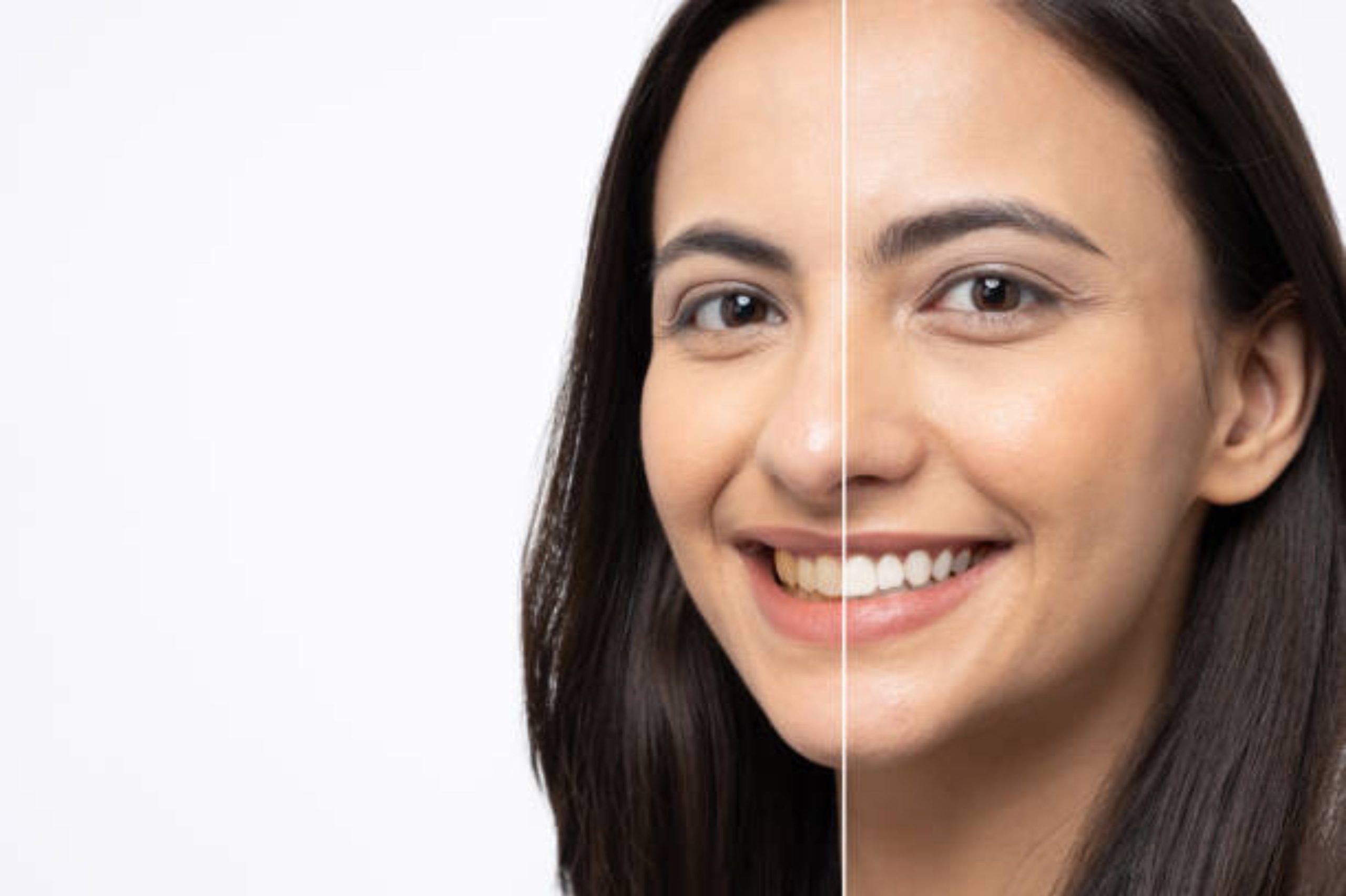 Bright white smile after professional dental whitening