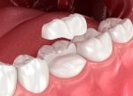 dental inlays treatment